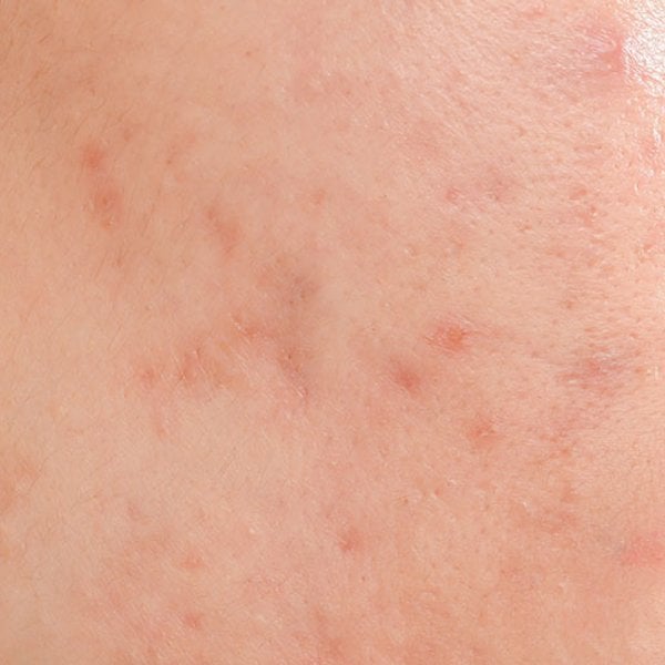 Acne Article - main image