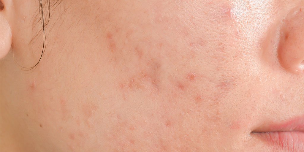 How to get rid of scars and marks par La Roche-Posay