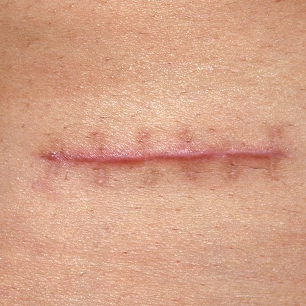 Scar from stitches How to prevent it : causes, treatments, products by La  Roche-Posay