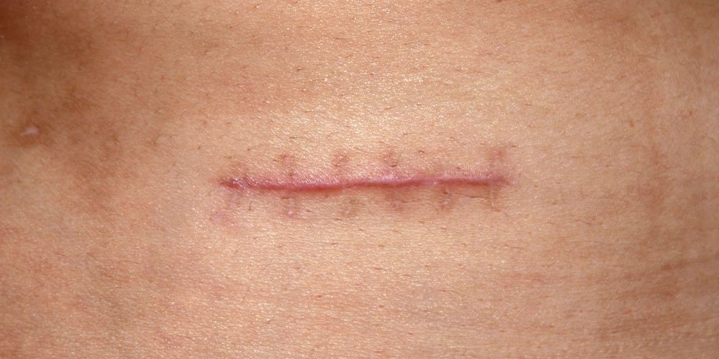 Scar from stitches How to prevent it : causes, treatments, products by La  Roche-Posay
