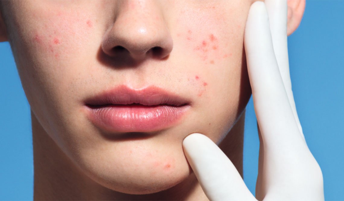 What Causes Oily Acne Prone Skin A Guide by La Roche Posay